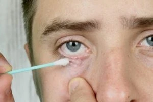 demodex treatments to use