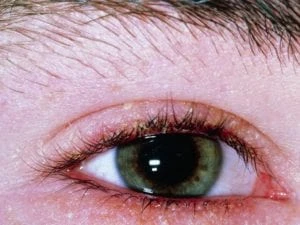 why are my eyelids red
