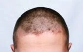 Seborrheic dermatitis eyelids