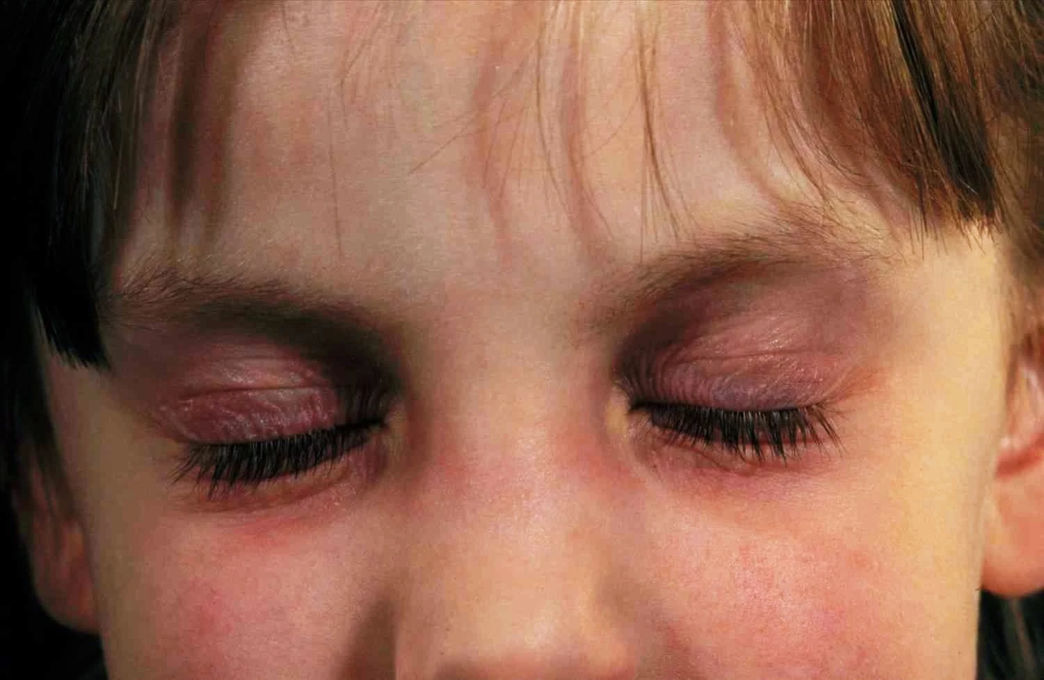 Seborrheic dermatitis eyelids