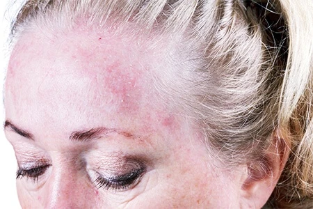 Seborrheic dermatitis eyelids