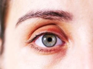 why are my eyelids red