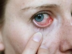 Eye Herpes Or Ocular Herpes Signs Symptoms Treatment Eye Love Cares