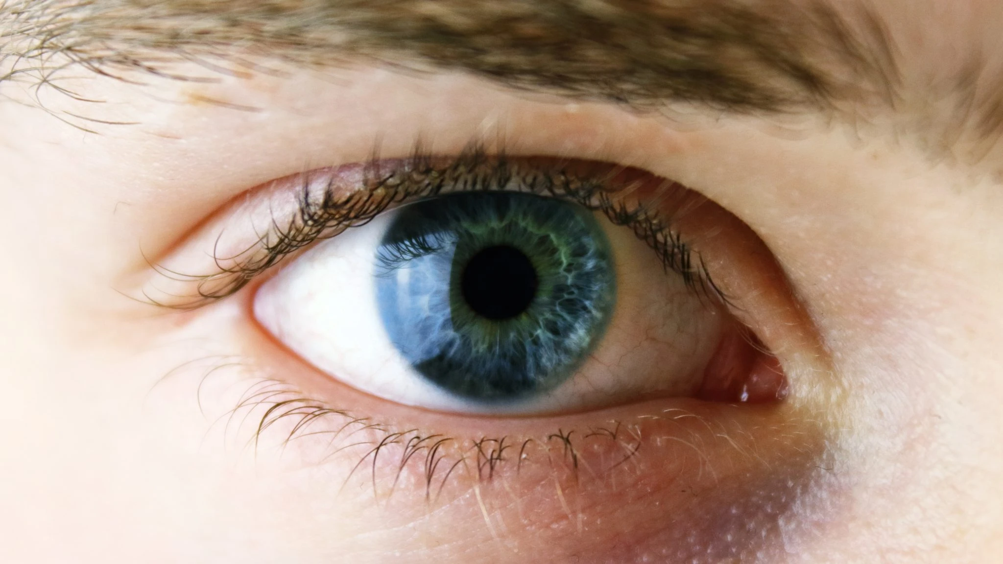 ocular herpes
