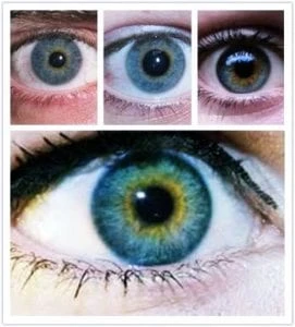 heterochromia